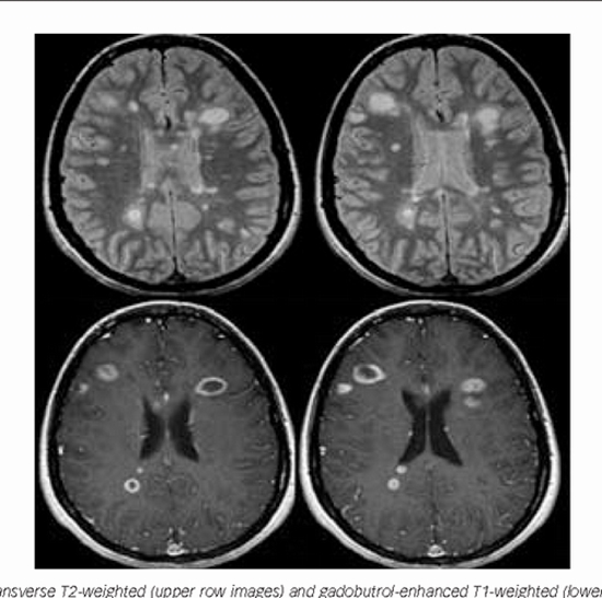 The relationship between enhanced plaques with Gadovist and Magnevist contrast brain magnetic resonance imaging and the neurolog {faces}